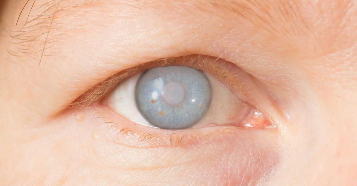 Understanding Cataracts Causes Symptoms Treatment And Prevention Northeastern Eye Institute 